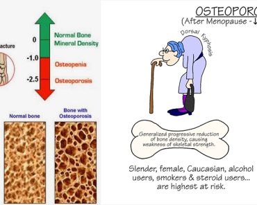 Osteoporosis – Everything a women should know!