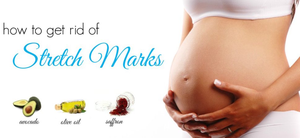6 Best Home Remedies for Stretch Marks